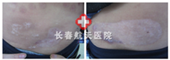 治疗后.png