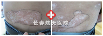 治疗前.png